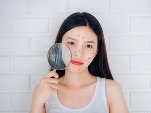 Diet untuk Hilangkan Jerawat Viral di TikTok, Ini Pendapat Dermatologist