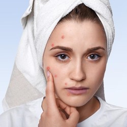 Jerawat itu Muncul Gegara Hormonal atau Bakteri? Ini Kata Dokter Kulit