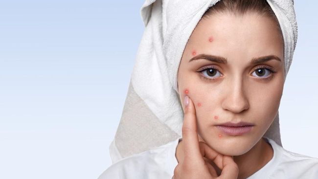 Experts Call This Acne Drug The First Breakthrough In 40 Years