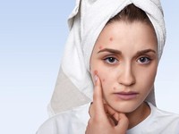 Jerawat itu Muncul Gegara Hormonal atau Bakteri? Ini Kata Dokter Kulit