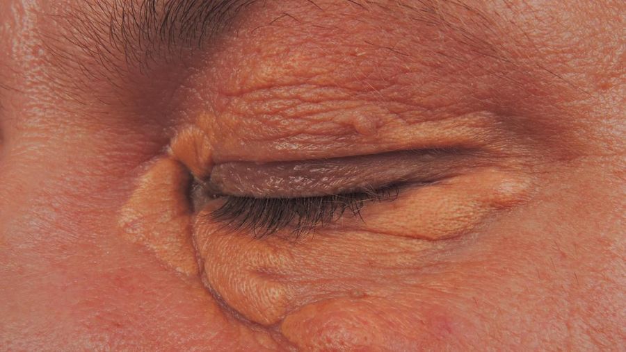 Xanthelasma patch (Photo by: BSIP/Universal Images Group via Getty Images)