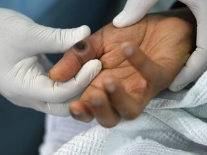 Alert! Varian Ganas Mpox Clade Ib Sudah Masuk India, Begini Kondisi Pasien