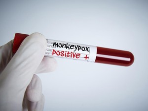 Kasus Cacar Monyet di RI Meroket, Diprediksi Bisa Capai 3.600