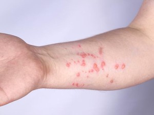 Satu Orang Warga Asal Kota Bandung Positif Monkey Pox