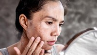Serum Dark Spot untuk Bekas Jerawat dan Flek, Apa yang Perlu Diperhatikan? 