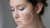 Sudah Pakai Acne Patch Tapi Jerawat Nggak Kempes? Cek 6 Kesalahan Ini