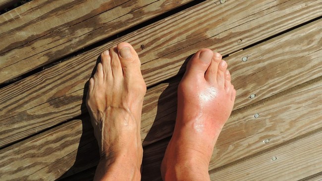 5 Kebiasaan Pagi Ini Efektif Kendalikan Asam Urat, Mudah dan Praktis