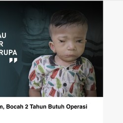 Ini Afriliam, Bocah 2 Tahun Butuh Operasi Rekonstruksi Wajah
