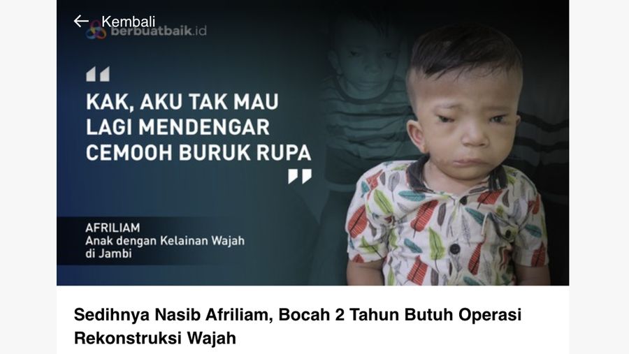 Sedihnya Nasib Afriliam, Bocah 2 Tahun Butuh Operasi Rekonstruksi Wajah. (Tangkapan Layar berbuat baik.id)