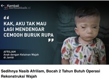 Ini Afriliam, Bocah 2 Tahun Butuh Operasi Rekonstruksi Wajah