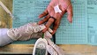 13 Tanda Diabetes yang Muncul di Kulit, Jangan Disepelekan!