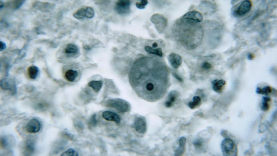 Photomicrograph dari spesimen jaringan otak ini menggambarkan perubahan cytoarchitectural yang terkait dengan infeksi amuba yang hidup bebas, yang mungkin disebabkan oleh Naegleria fowleri, atau Acanthamoeba sp. Naegleria fowleri menghasilkan penyakit sistem saraf pusat (SSP) yang akut dan biasanya mematikan yang disebut primary amebic meingoencephalitis (PAM). Trofozoit menginfeksi manusia atau hewan dengan memasuki neuroepitel penciuman dan mencapai otak. Trofozoit N. fowleri ditemukan dalam cairan serebrospinal (CSF) dan jaringan, sedangkan bentuk flagellated kadang-kadang ditemukan di CSF. (Smith Collection/Gado/Getty Images).