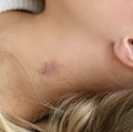 Cupang di Leher Bisa Picu Stroke & Kematian, Ini Buktinya