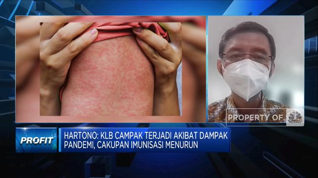 Watch out!  Cases Increase 32 Times, Indonesia Measles Outbreak