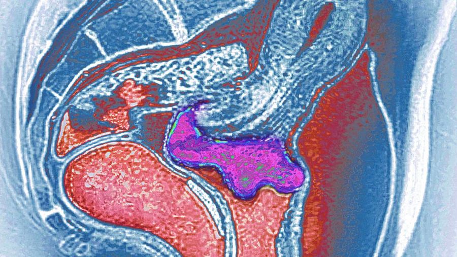Cervical cancer visualized by sagittal MRI, papillomavirus infection is often the cause. (Photo by: CAVALLINI JAMES/BSIP/Universal Images Group via Getty Images)