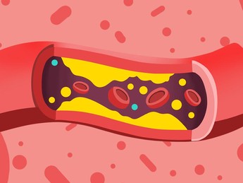 Tidak Perlu Obat, Buah-Buahan Ini Ampuh Turunkan Kolesterol