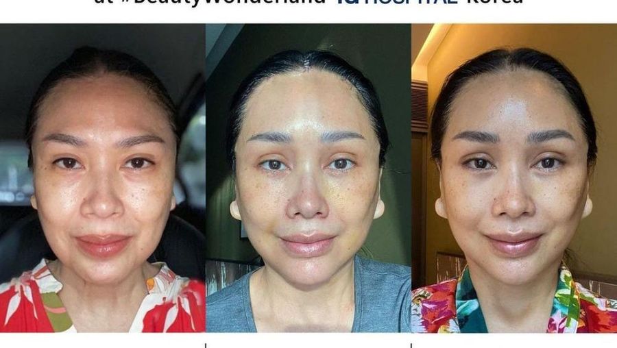 Penyanyi diva Indonesia Titi DJ baru-baru ini membagikan pengalamannya melakukan operasi anti aging atau anti penuaan di Gangnam, Korea Selatan pada 6 Januari lalu. (Tangkapan layar instagram @ti2dj)