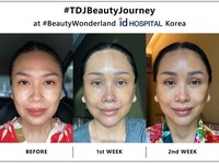 Pantesan Bikin Pangling, Ini 5 Operasi yang Dijalani Titi DJ