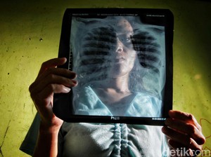 Dinkes Surabaya Prediksi Kasus ISPA Meningkat Saat Musim Hujan