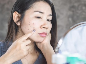 Dark Spot Adalah Bercak Gelap pada Kulit, Begini Cara Menghilangkannya!