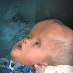 Kisah Sedih Anak Pekerja Serabutan yang Alami Hidrosefalus