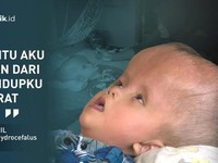 Kisah Sedih Anak Pekerja Serabutan yang Alami Hidrosefalus
