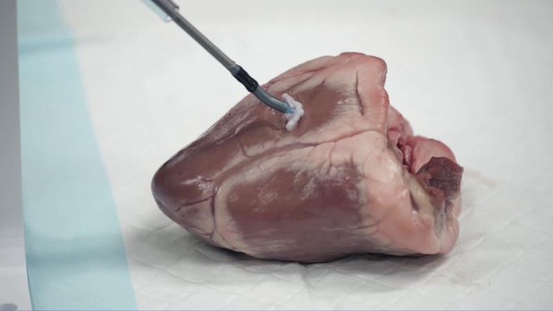 Sebuah tim insinyur biomedis di Australia telah mengembangkan robot fleksibel kecil untuk mencetak biomaterial 3D langsung di dalam tubuh manusia. Sebuah tim insinyur biomedis di Australia telah mengembangkan robot fleksibel kecil untuk mencetak biomaterial 3D langsung di dalam tubuh manusia. (Tangkapan Layar VIdeo Reuters)