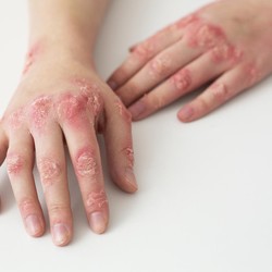 Banyak Warga Singapura Kena Herpes Zoster, Diduga Terkait Covid