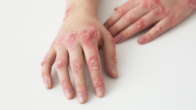 Banyak Warga Singapura Kena Herpes Zoster, Diduga Terkait Covid