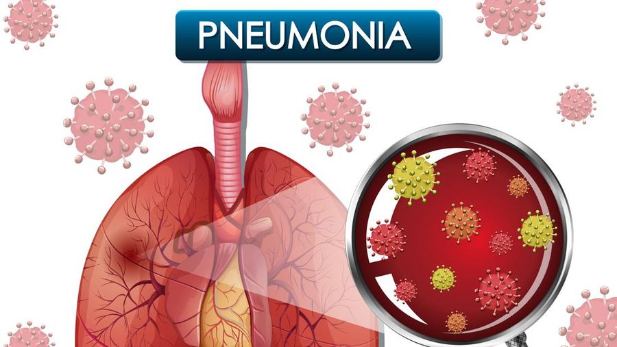 Ilustrasi Penyakit Pneumonia. (Dok. Freepik)