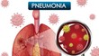Awas Mendadak Mati Gegara Flu, Cegah dengan Cara Mudah Ini