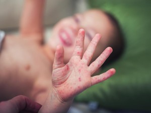 Apa Itu Virus Campak? Ini Pengertian, Penyebab, dan Cara Penularannya