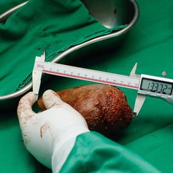 5 Pantangan Setelah Operasi Batu Ginjal, Simak!