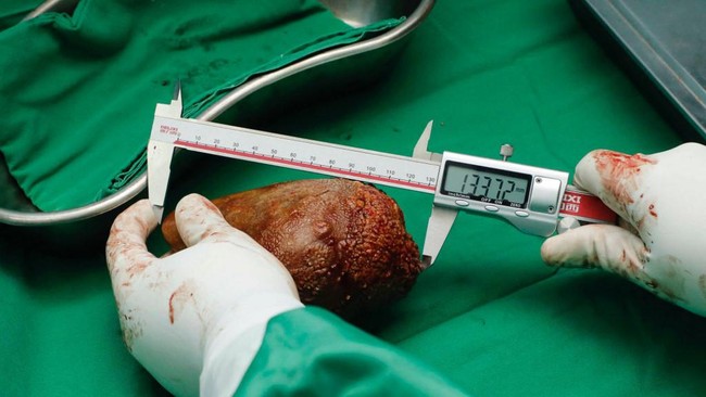 5 Kebiasaan Sepele Ini Bisa Picu Batu Ginjal, Stop Sekarang!