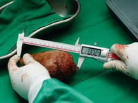 5 Pantangan Setelah Operasi Batu Ginjal, Simak!