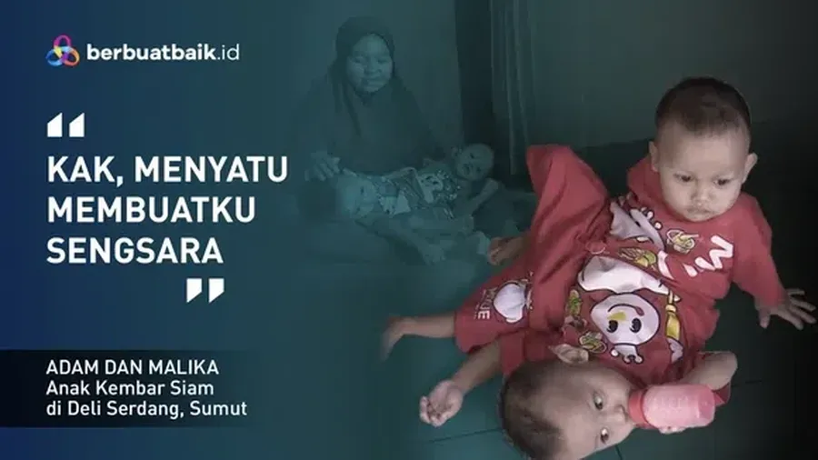 Adam dan Malika, Kembar Siam Berbagi Kaki yang Bergantung pada Ayah Kuli Serabutan. (berbuatbaik.id)