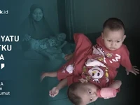 Kembar Siam Ini Harus Berbagi Kaki, Bergantung Pada Ayah Kuli