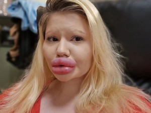 Wanita dengan Bibir Terbesar Tambah Filler untuk Natal, Bikin Takut Keluarga