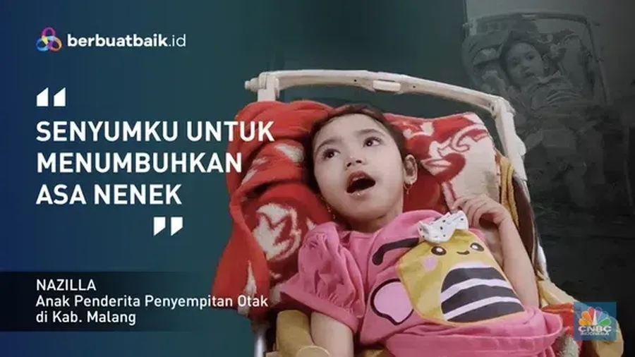Senyum Tegar Nazila, Bocah Yatim Piatu Alami Penyempitan Otak. (Dok. berbuatbaik.id)