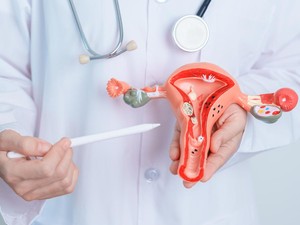 Benarkah Tumbuh Rambut Berlebihan pada Wanita Tanda PCOS? Dokter Bilang Gini
