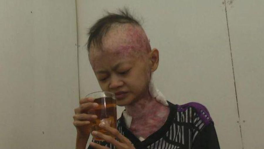 Komarudin atau Omang (26) memiliki kelainan kulit yang dideritanya. (Dok. Berbuat Baik)