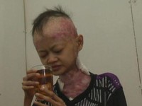 Kisah Pilu Omang, Penderita Kelainan Kulit yang Kurus Kering