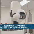 Video: Elon Musk Tanam Chip Pertama Ke Otak Manusia
