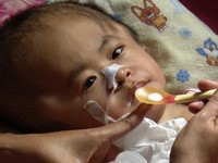 Keluarga Tukang Bengkel Jemput Kesembuhan Anak Hidrosefalus