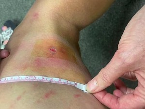 Kasihan Sekali Turis Australia Kena Tomcat di Bali, Kakinya sampai Melepuh