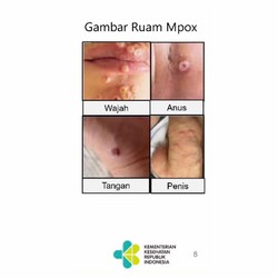 Gejala Cacar Monyet yang Mirip Radang Amandel