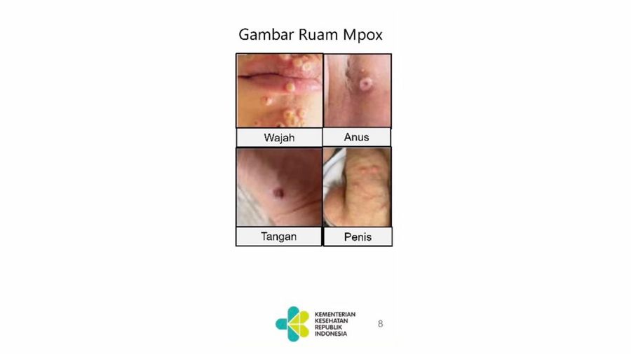 Gejala cacar monyet. (Dok Kemenkes)