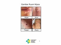 Gejala Cacar Monyet yang Mirip Radang Amandel
