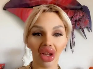 Wanita Ini Filler Bibir Hasilnya Bikin Ngeri, Bibirnya Seperti Mau Meledak