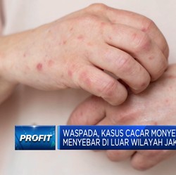 Cegah Cacar Monyet Meluas, Kemenkes Siapkan Obat & Vaksinasi